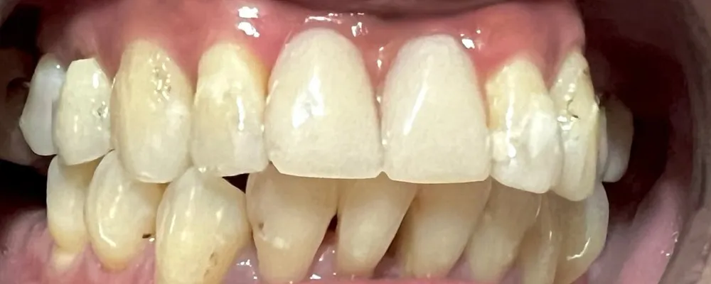 After: Missing front teeth replaced