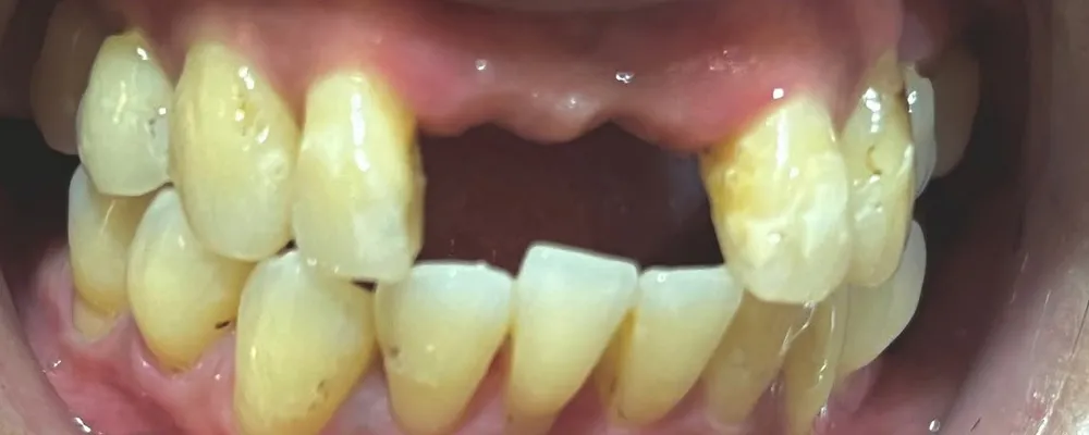 Before: Missing front teeth replaced