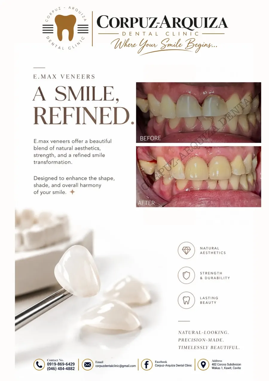 E.max veneers: a smile, refined, before and after