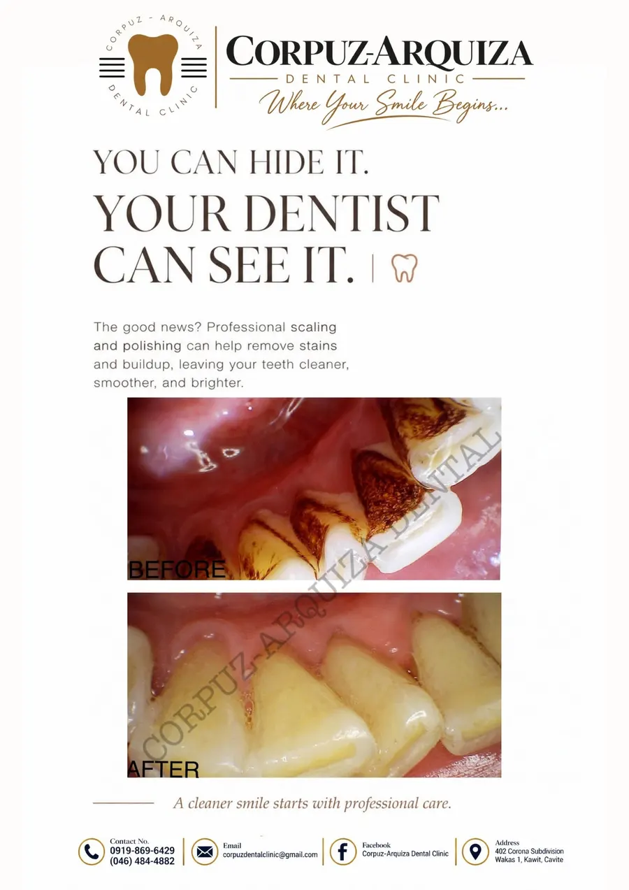 Scaling and polishing: stains and buildup removed, before and after