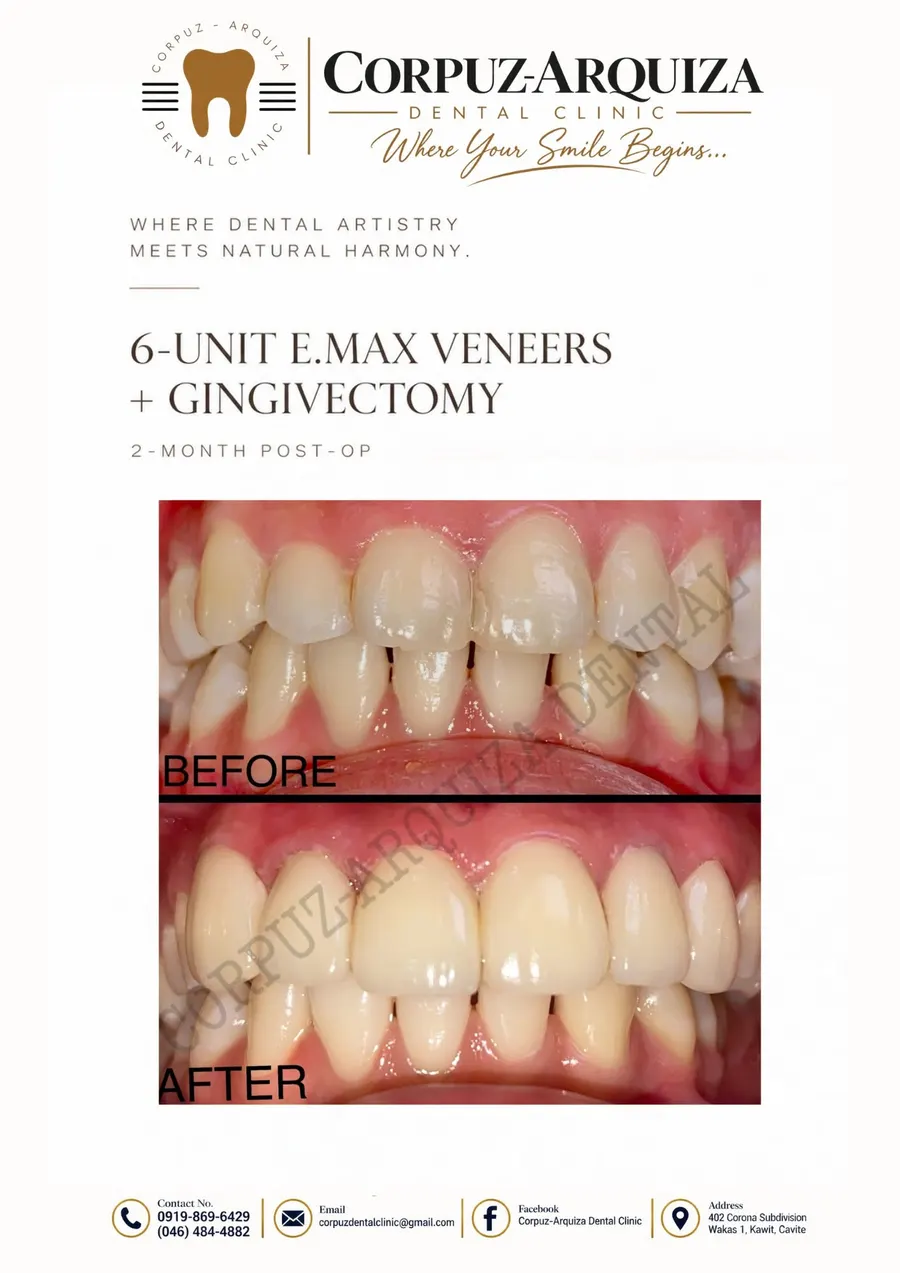 6-unit E.max veneers plus gingivectomy, before and after, 2 months post-op