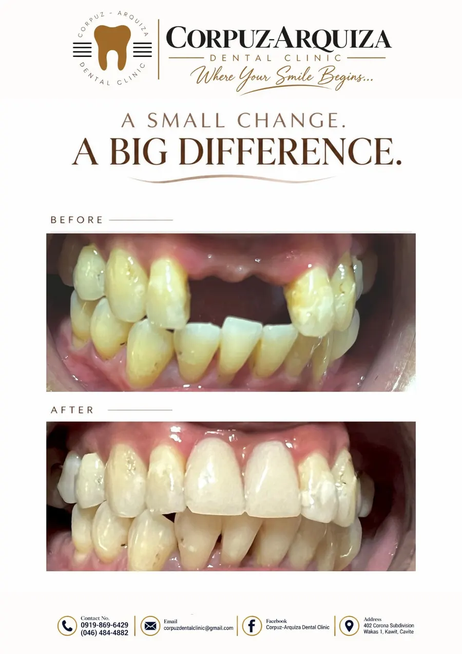 A small change, a big difference: missing front teeth replaced, before and after