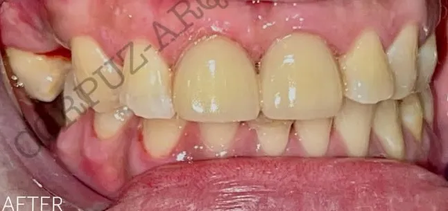 After: E.max veneers