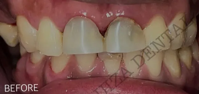 Before: E.max veneers