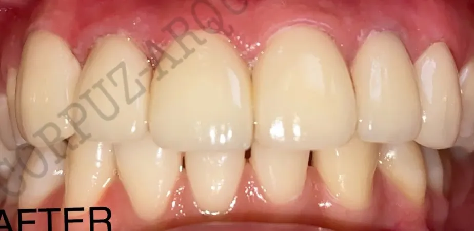 After: 6-unit E.max veneers + gingivectomy