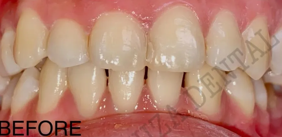 Before: 6-unit E.max veneers + gingivectomy